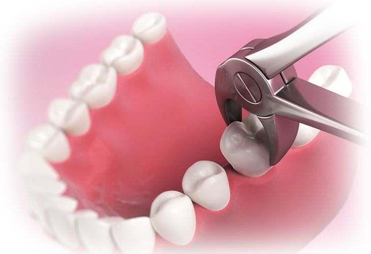 Особенности удаления зубов при одномоментной имплантации