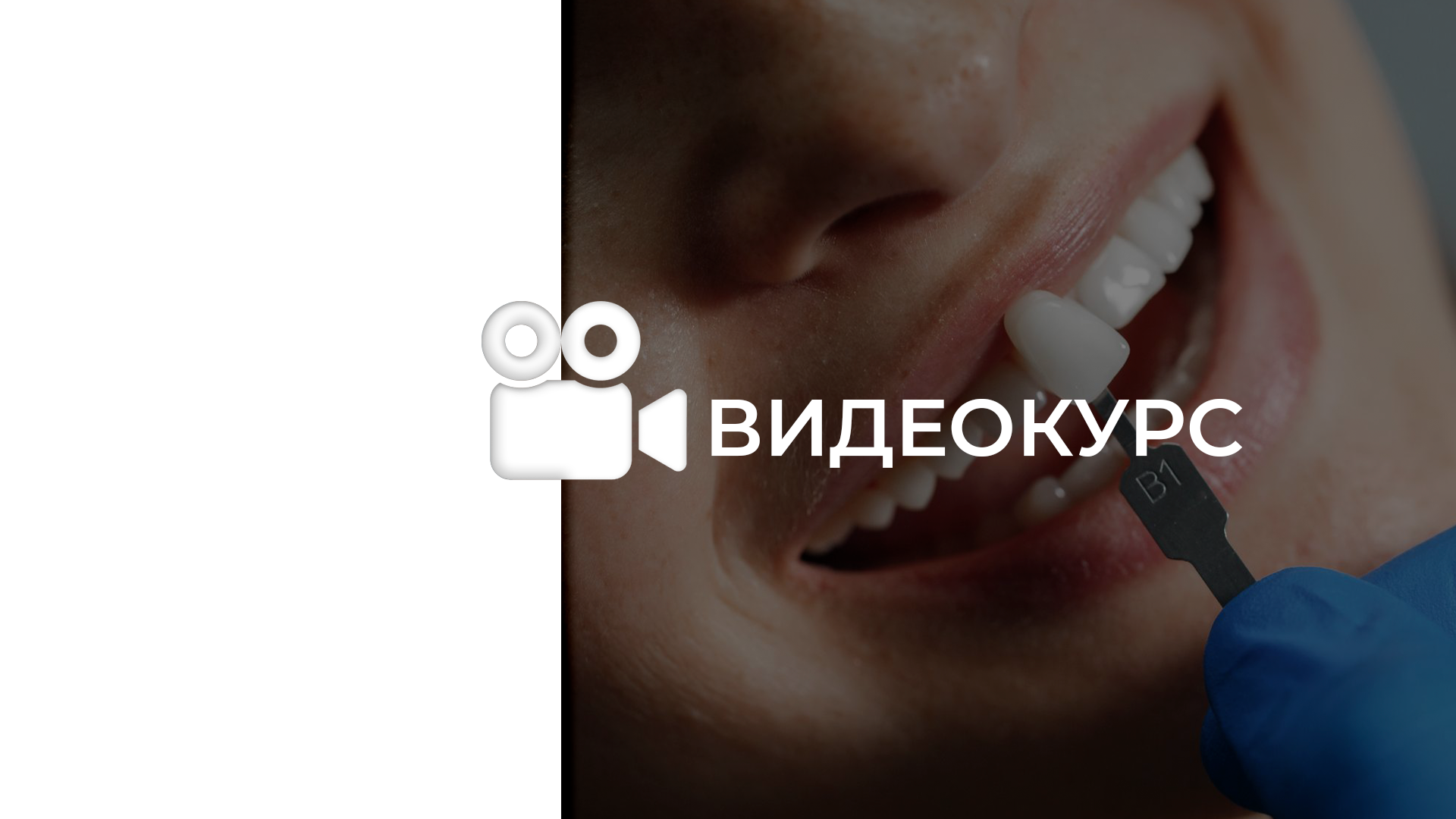 Реставрация фронтального резца при сквозном дефекте — 4 класс. Послойная техника
