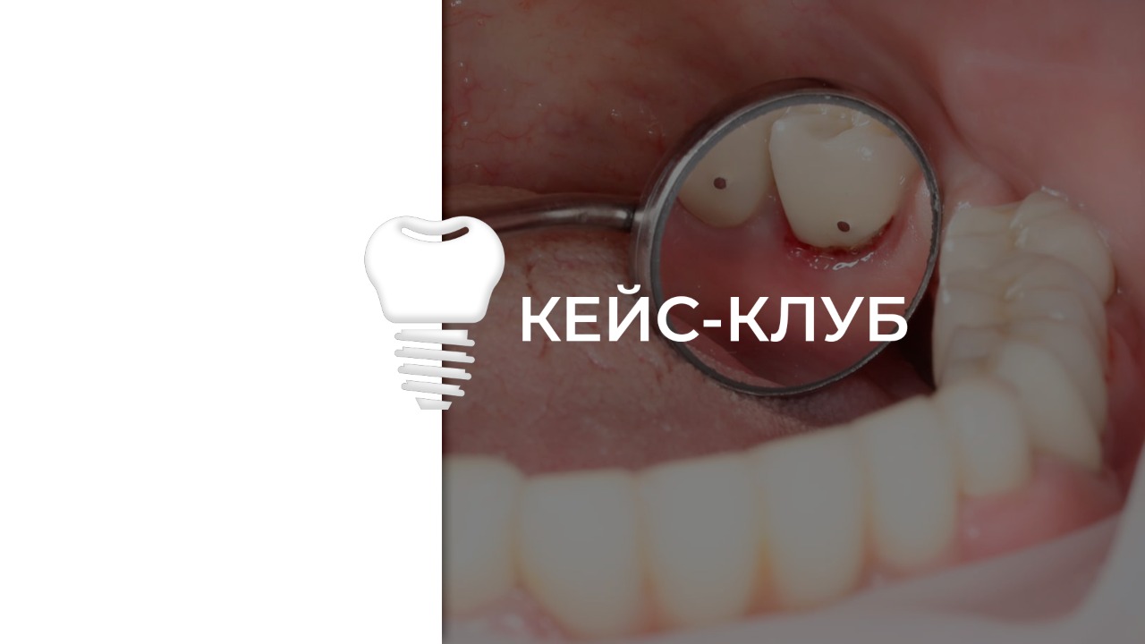 Кейс-клуб. Профилактика осложненй имплантологического лечения.  Таргетная иммунокоррекция. Фотодинамическая терапия.