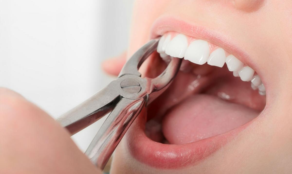 Особенности удаления зубов при одномоментной имплантации