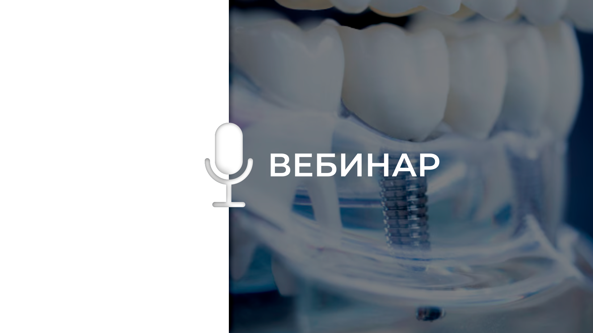 Дентальная имплантация с изготовлением индивидуального заживляющего абатмента