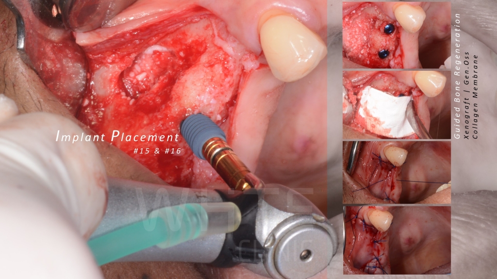 Установка имплантатов частично беззубому пациенту с инвертированным изгибом челюсти