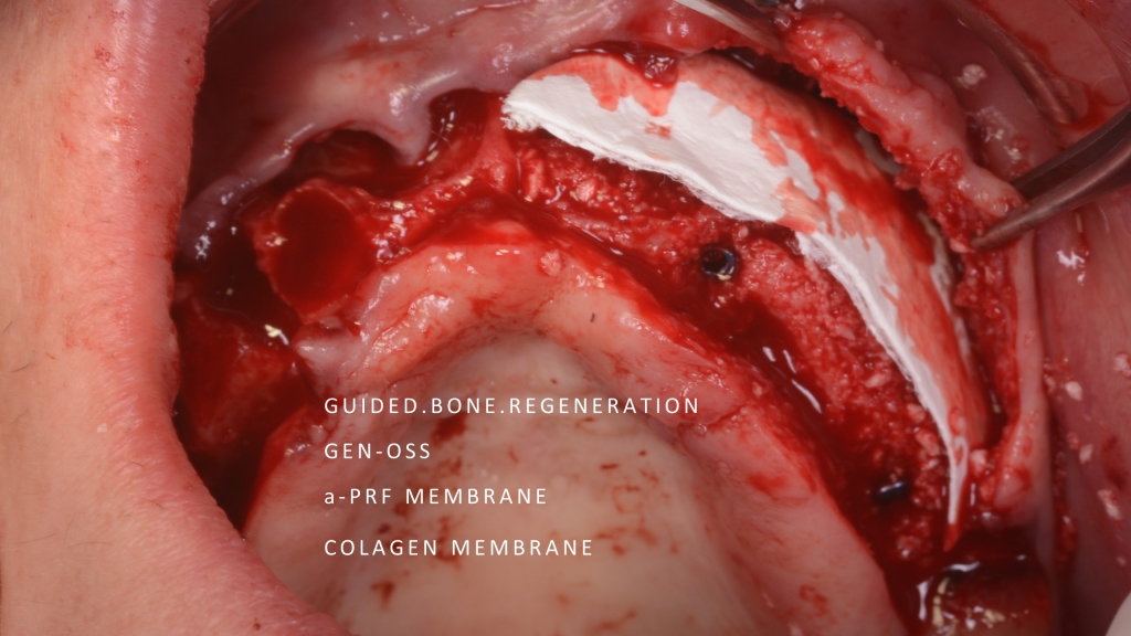 Установка имплантата Megagen и направленная регенерация кости