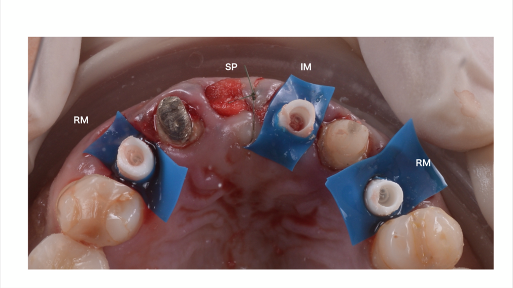 Клинический случай MINEC. Менеджмент мягких тканей вокруг имплантатов в эстетической зоне Хаяши Йошихару - фото 6