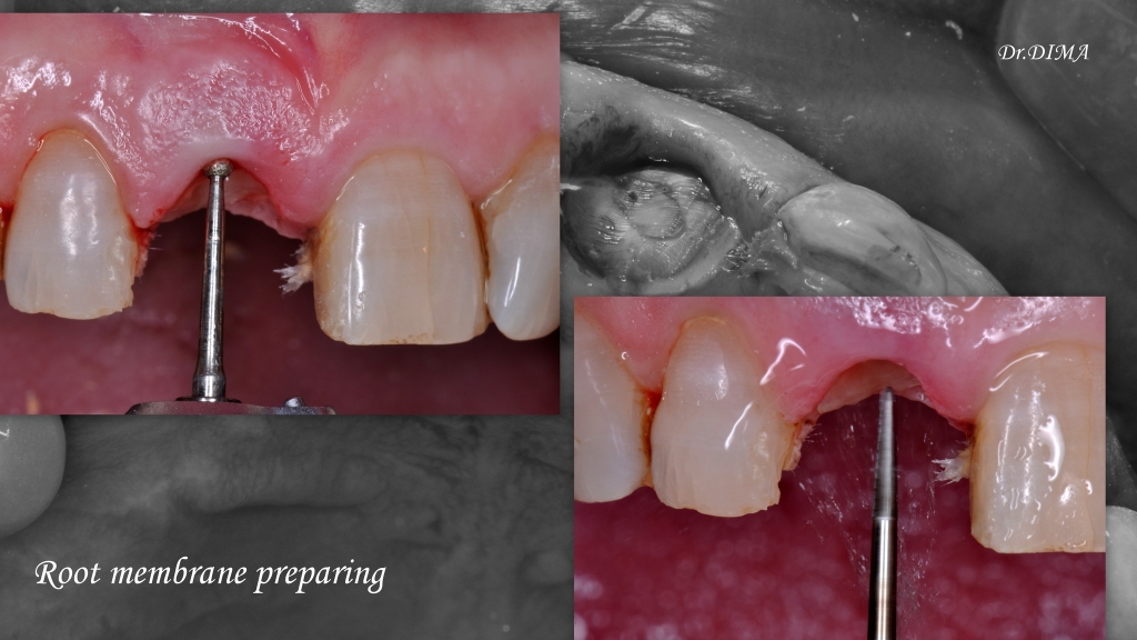Корневая мембрана и одномоментное протезирование с имплантатом AnyRidge - Хирургическая процедура фото 7.jpg