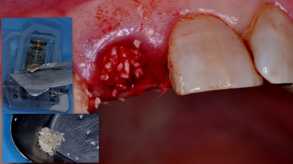 Корневая мембрана и одномоментное протезирование с имплантатом AnyRidge - Хирургическая процедура фото 18.jpg
