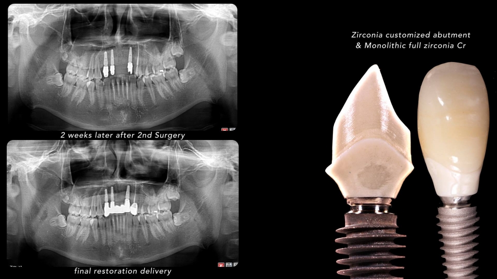 Направленная костная регенерация с последующей имплантацией Anyridge