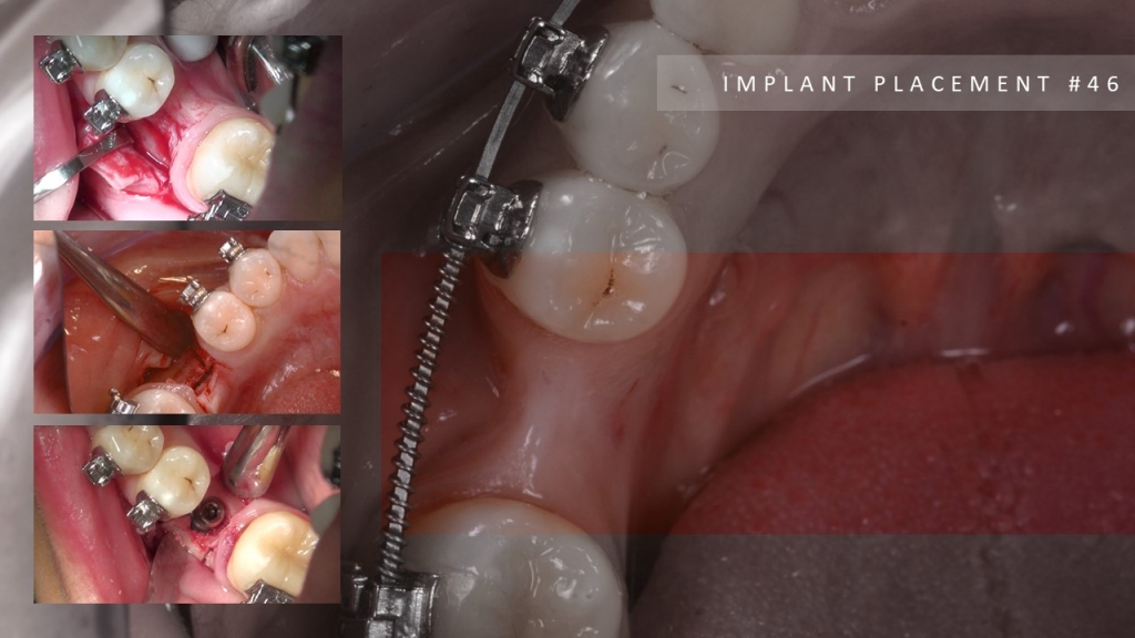 Единичная установка имплантата после ортодонтичного лечения