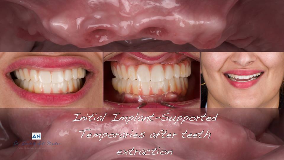 Полная реабилитация полости рта с помощью имплантатов AnyRidge