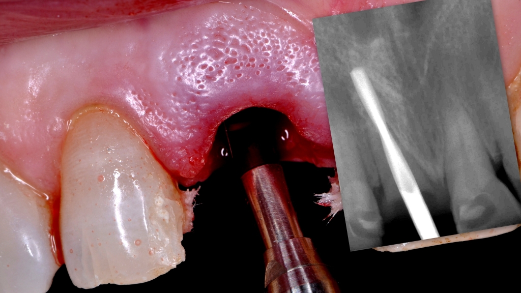 Корневая мембрана и одномоментное протезирование с имплантатом AnyRidge - Хирургическая процедура фото 12.jpg