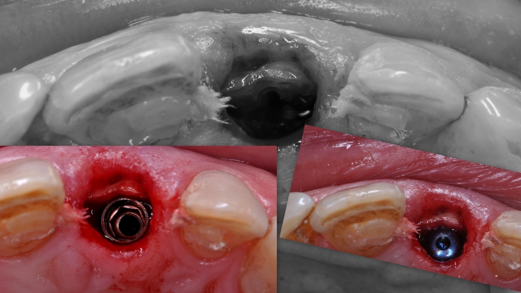 Корневая мембрана и одномоментное протезирование с имплантатом AnyRidge - Хирургическая процедура фото 17.jpg