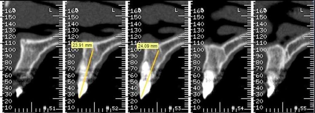 Корневая мембрана и одномоментное протезирование с имплантатом AnyRidge - Хирургическая процедура фото 3.jpg