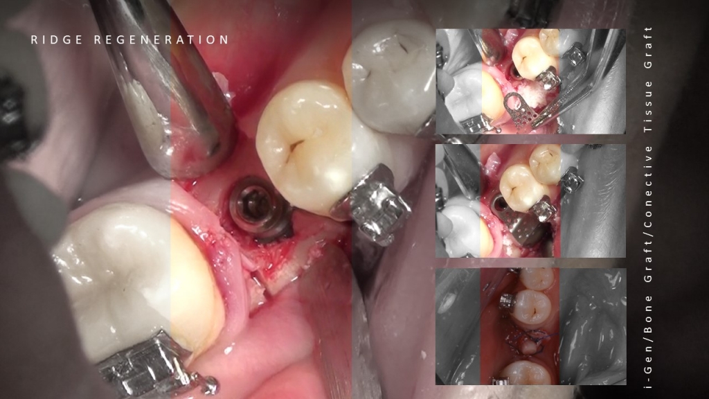 Единичная установка имплантата после ортодонтичного лечения