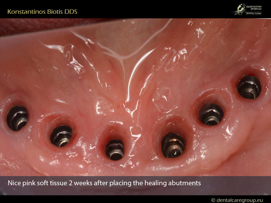 Реабилитация нижней челюсти с помощью 6 имплантатов Anyridge_Konstantinos Biotis