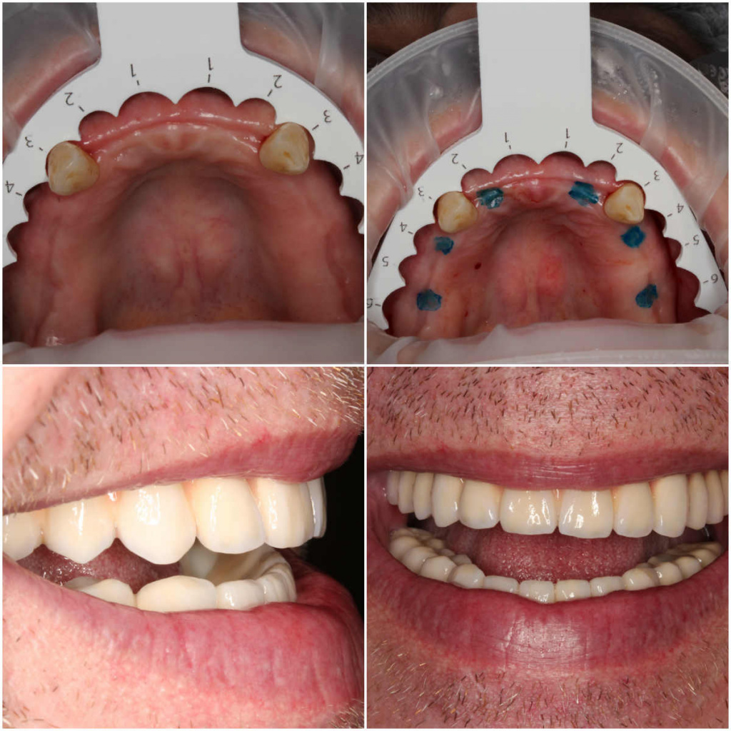 протезирование при полном отсутствии зубов.jpg