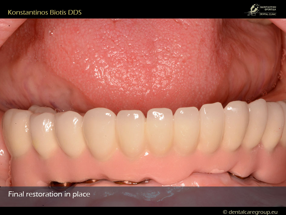 Реабилитация нижней челюсти с помощью 6 имплантатов Anyridge_Konstantinos Biotis