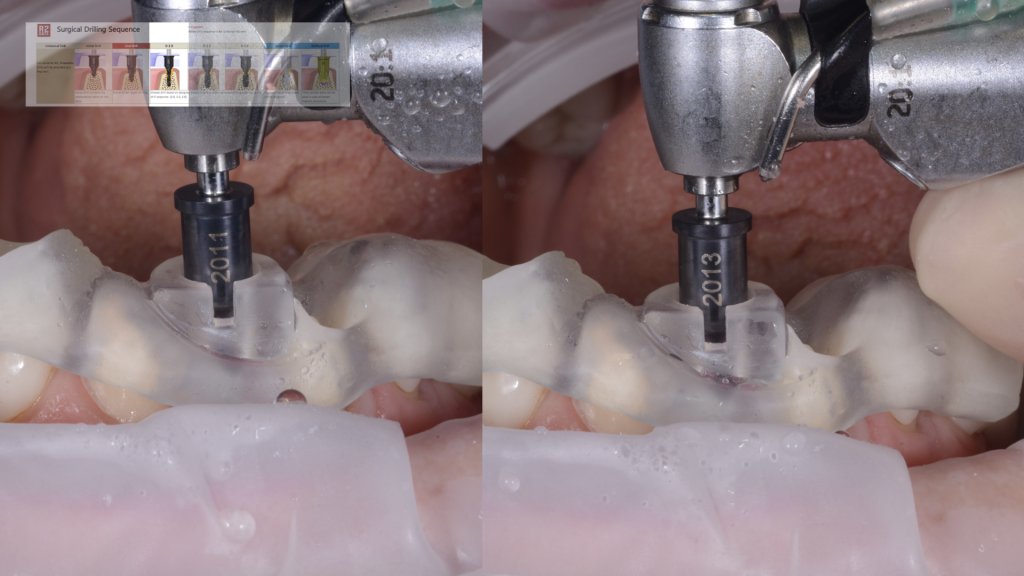 Виртуальное планирование дентальной имплантации: Хирургия с R2 Gate Часть 1 Мигель Стэнли изображение 18.png