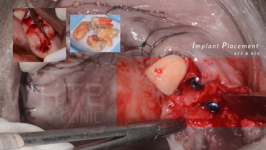 Установка имплантатов частично беззубому пациенту с инвертированным изгибом челюсти