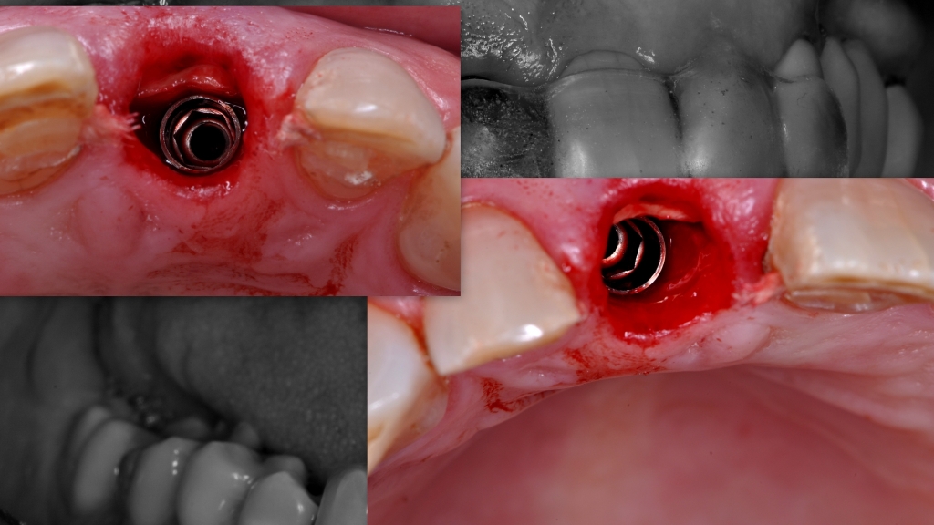 Корневая мембрана и одномоментное протезирование с имплантатом AnyRidge - Хирургическая процедура фото 15.jpg