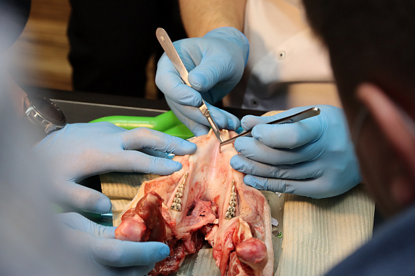 2 Дентальная имплантация с одновременной пластикой мягких тканей в сложных клинических случаях