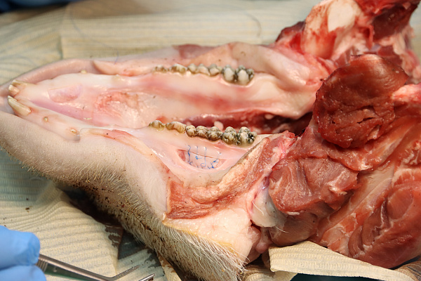 6 Дентальная имплантация с одновременной пластикой мягких тканей в сложных клинических случаях