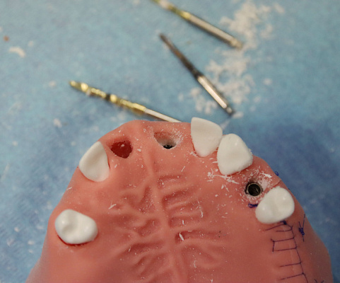 Одномоментная имплантация, немедленная нагрузка  (14)