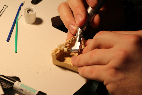 3 Прямые реставрации повышенной прочности. Эффективная альтернатива ортопедии: стекловолоконные каркасные конструкции - общая галерея