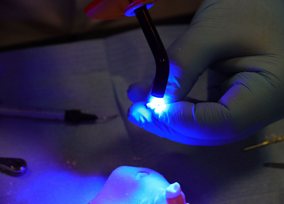 Одномоментная имплантация, немедленная нагрузка  (4)