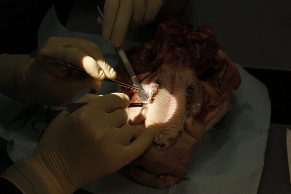 3 Пластика мягких тканей вокруг имплантатов. Морфологический подход - общая галерея